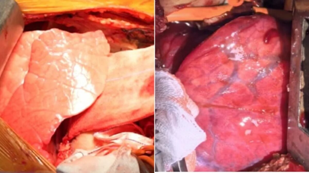 Médicos en China trasplantaron por primera vez un pulmón de cerdo a un hombre con muerte cerebral