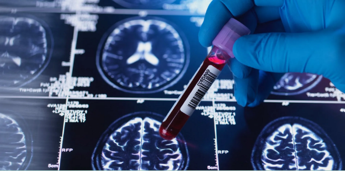 Identificaron biomarcadores para la detección temprana del alzhéimer en personas con síndrome de Down